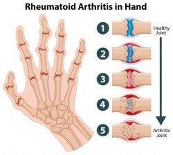 Diagram showing rheumatoid arthritis in a hand