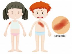 Diagram showing boy and girl with urticaria
